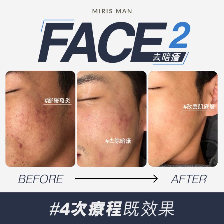 face2 before after 1